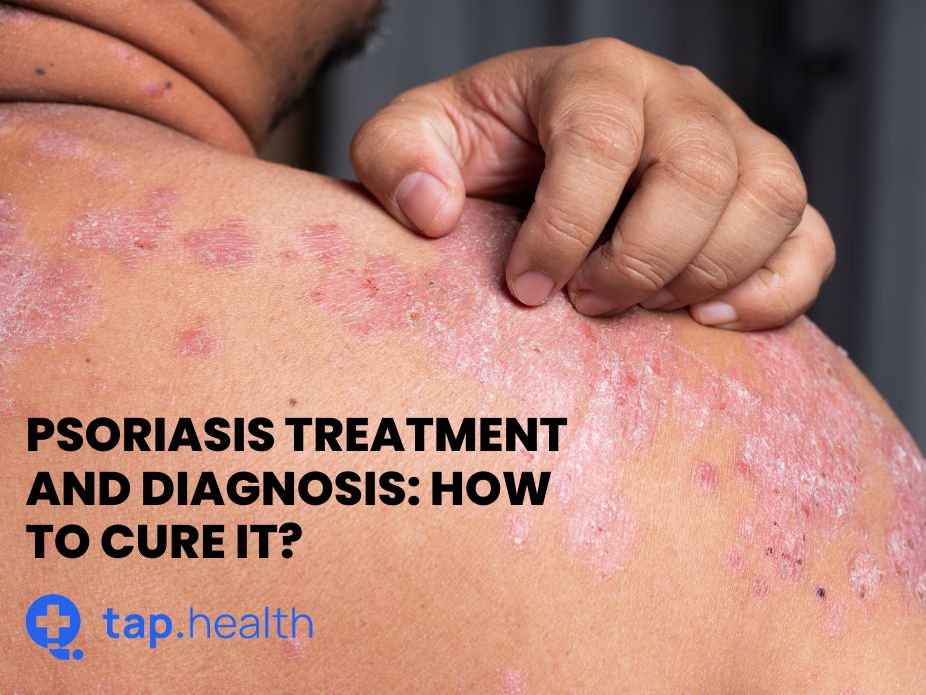Psoriasis Treatment And Diagnosis How To Effectively Manage And Cure 
