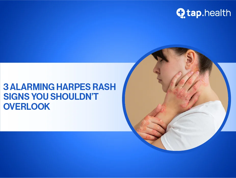 3-key-signs-its-time-to-consult-a-healthcare-professional-for-herpes-skin-rash