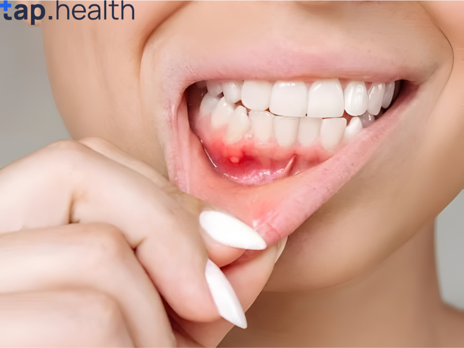 mouth-ulcers-revitalize-your-well-being-with-natures-healing-wonders