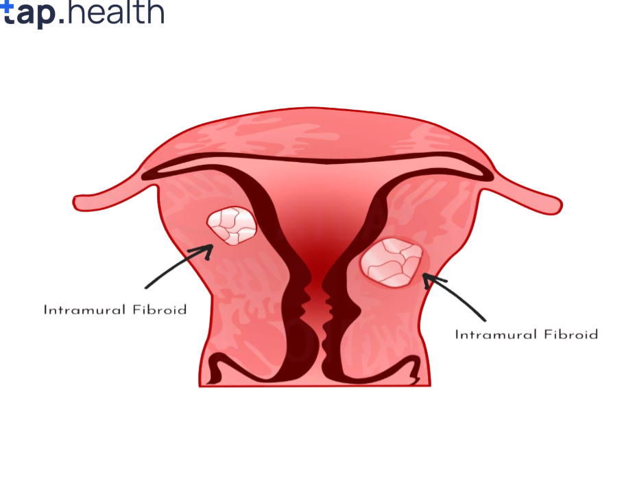 understanding-intramural-fibroids