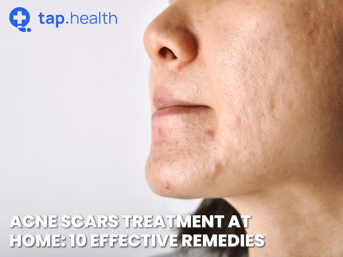 Acne Scars Treatment at Home