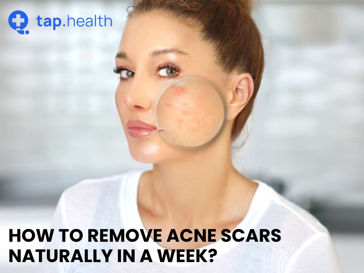 14-easy-and-natural-remedies-to-remove-acne-and-acne-scars-just-beet-it