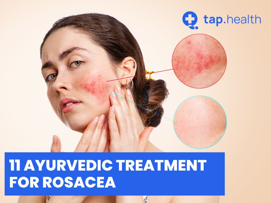 11 Ayurvedic Treatment For Rosacea