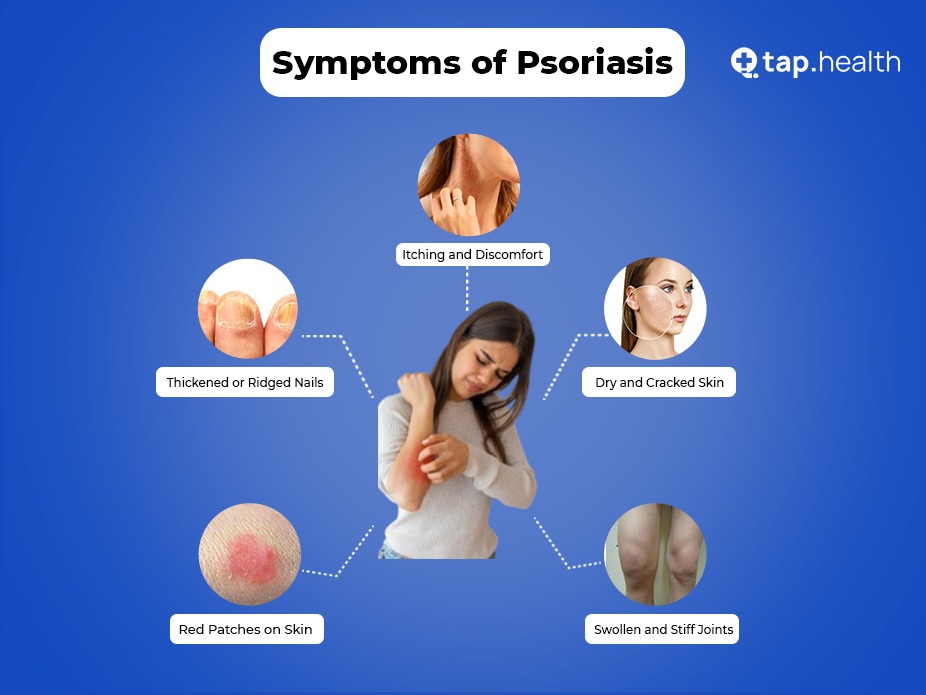 7 Symptoms of Psoriasis