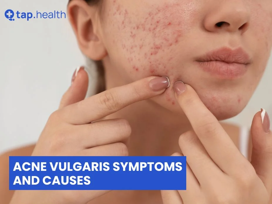 Acne Vulgaris Symptoms and Causes