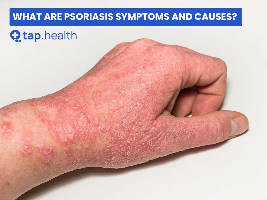 What are Psoriasis Symptoms and Causes