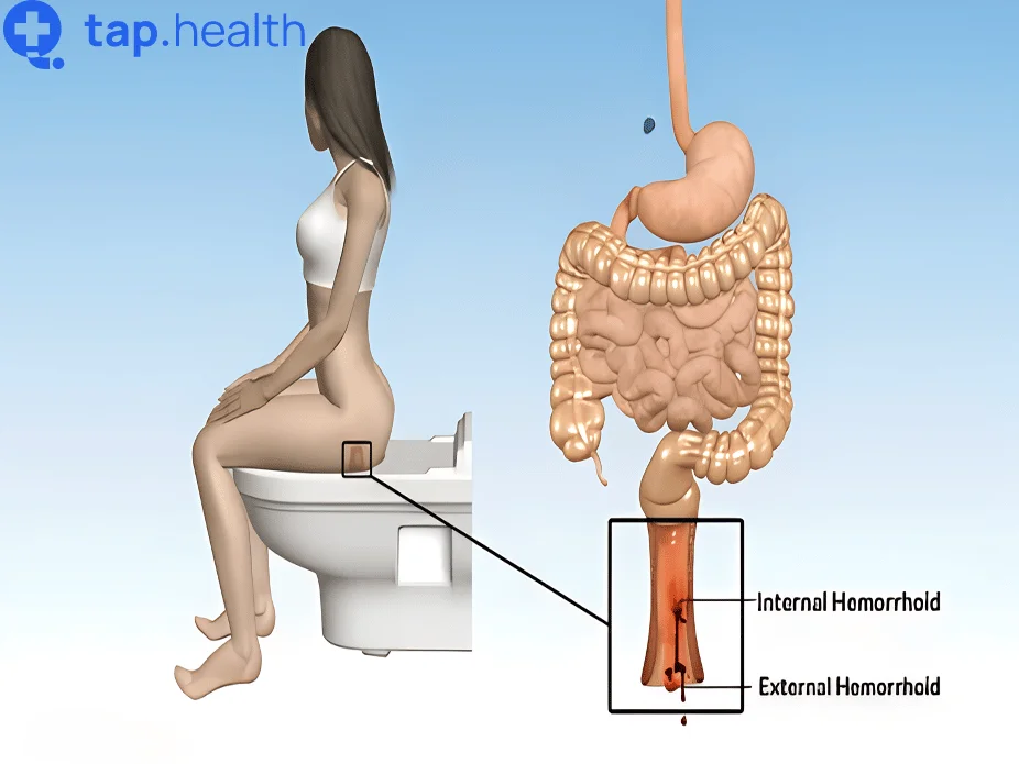 symptoms-of-piles-in-female-in-hindi