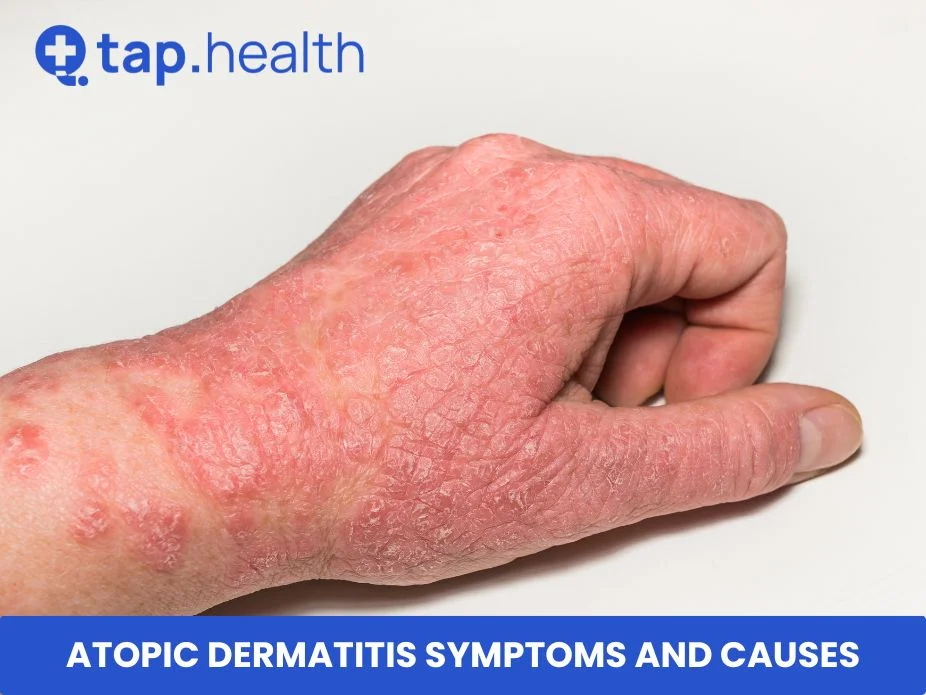 Atopic Dermatitis Symptoms and Causes