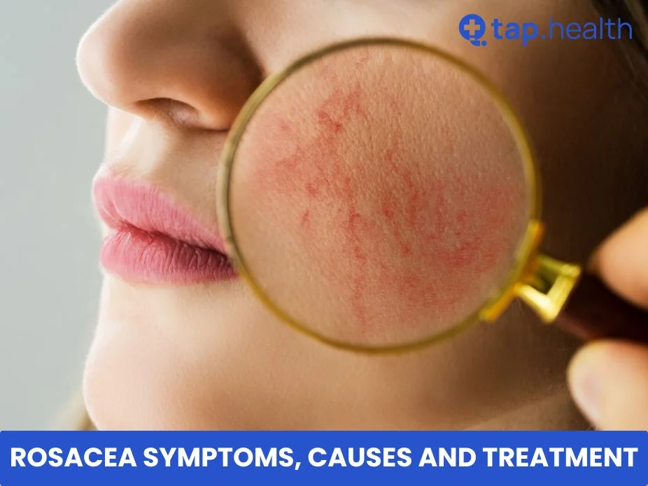 Rosacea Symptoms, Causes and Treatment