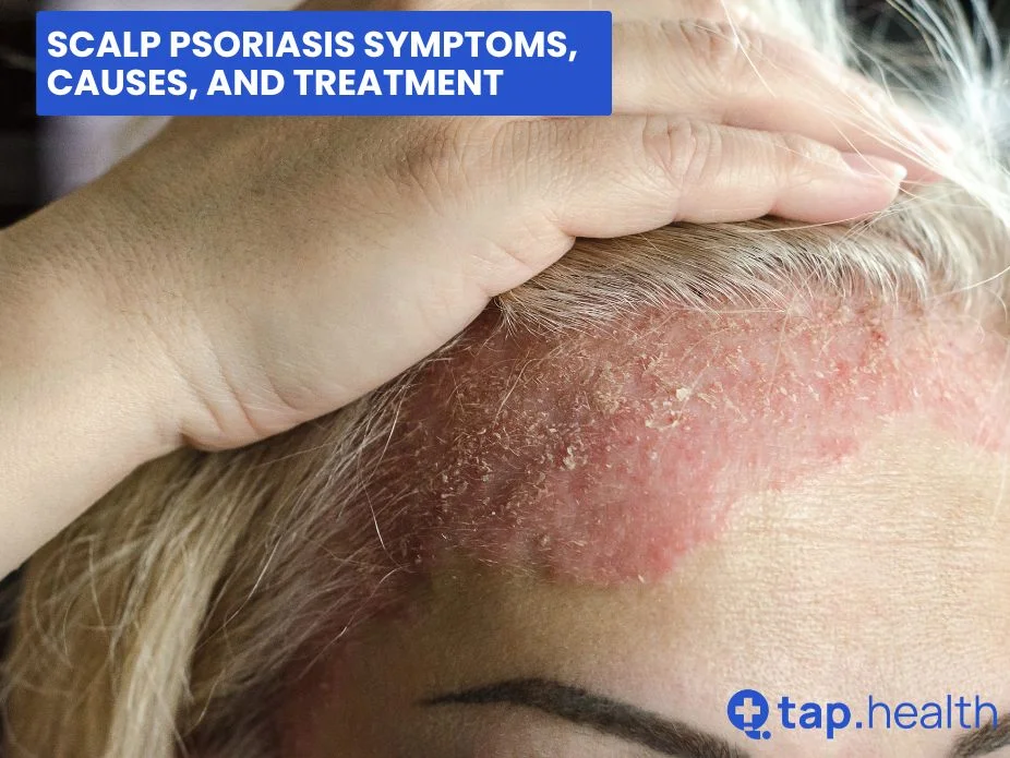 Scalp Psoriasis Symptoms, Causes, and Treatment