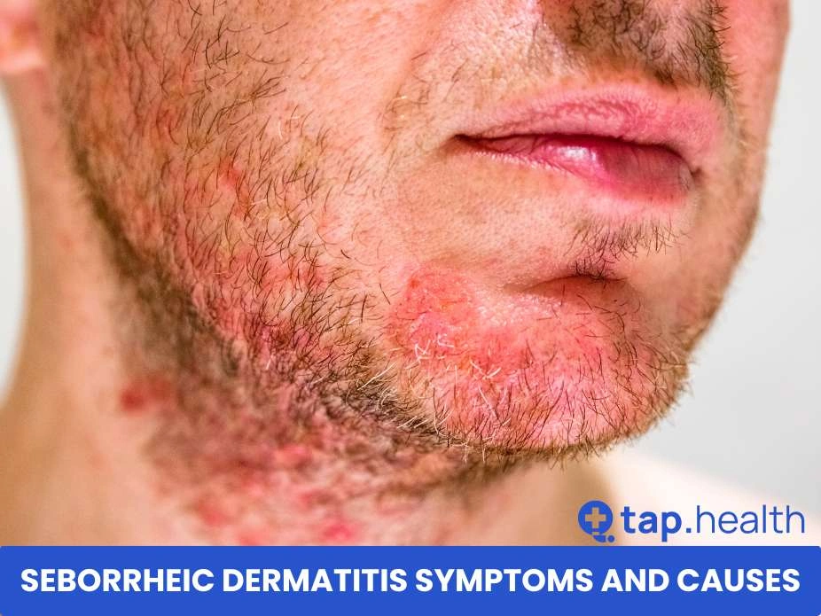 Seborrheic Dermatitis Symptoms and Causes