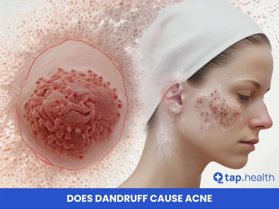 does dandruff cause acne