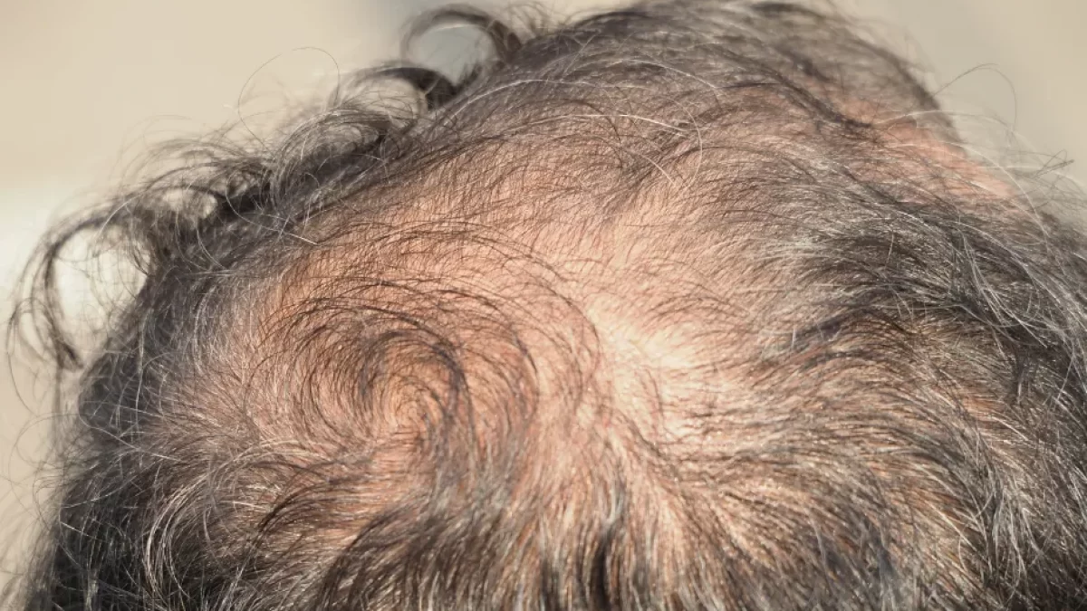 Does Diabetes Cause Hair Loss Understand the Connection