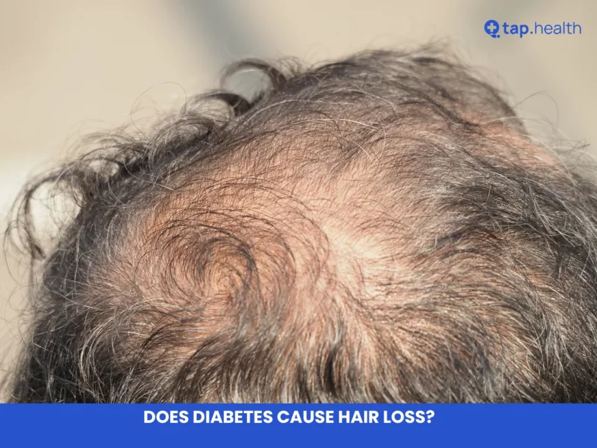 Does Diabetes Cause Hair Loss Understand the Connection