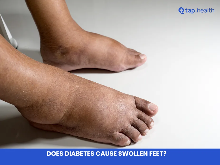 Does Diabetes Cause Swollen Feet?