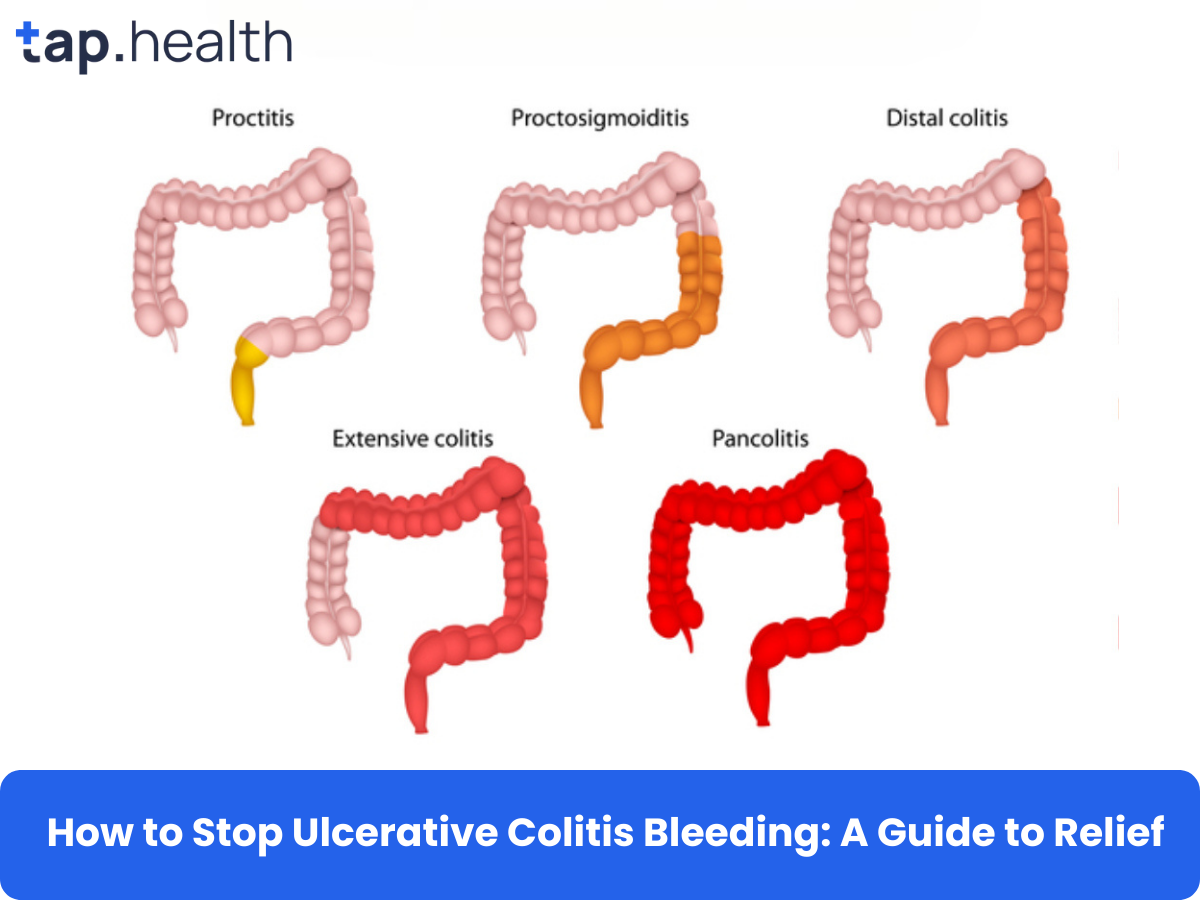 how-to-stop-ulcerative-colitis-bleeding-a-guide-to-relief