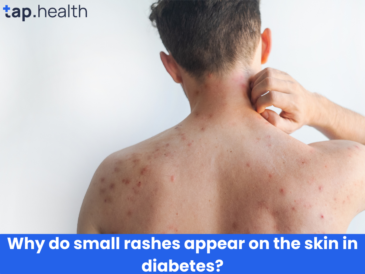 डायबिटीज़ त्वचा पर दाने