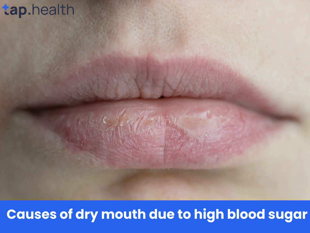 उच्च ब्लड शुगर में मुंह सूखने का कारण