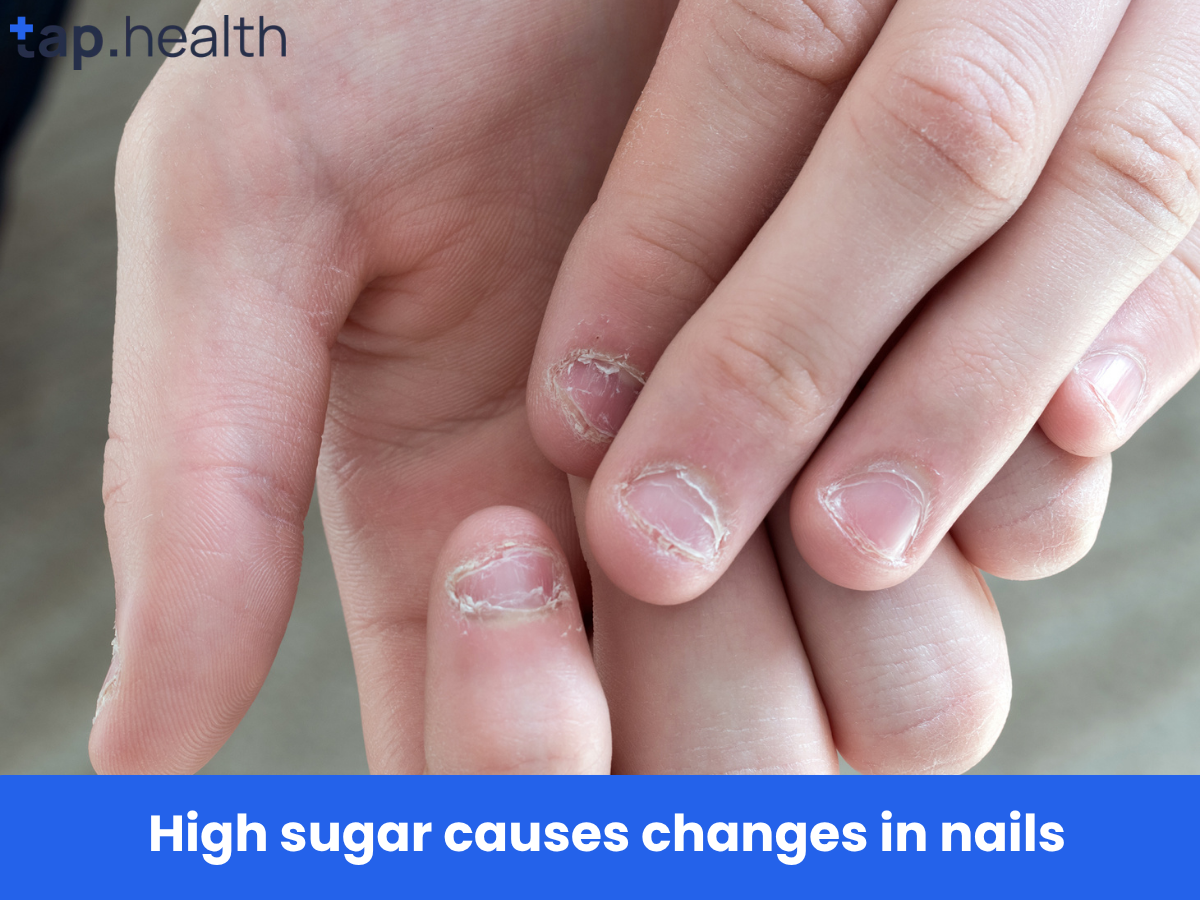 High sugar causes changes in nails