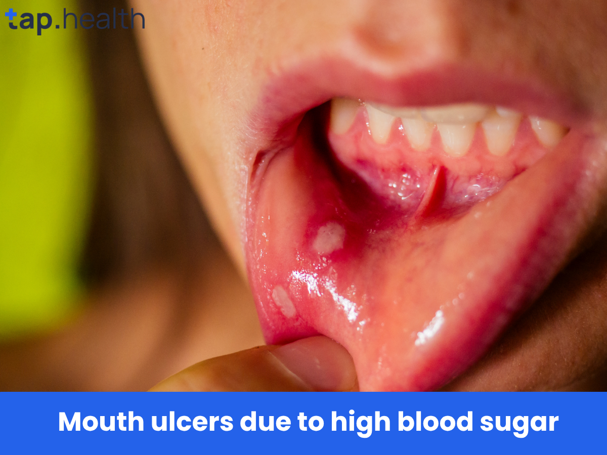 Mouth ulcers due to high blood sugar