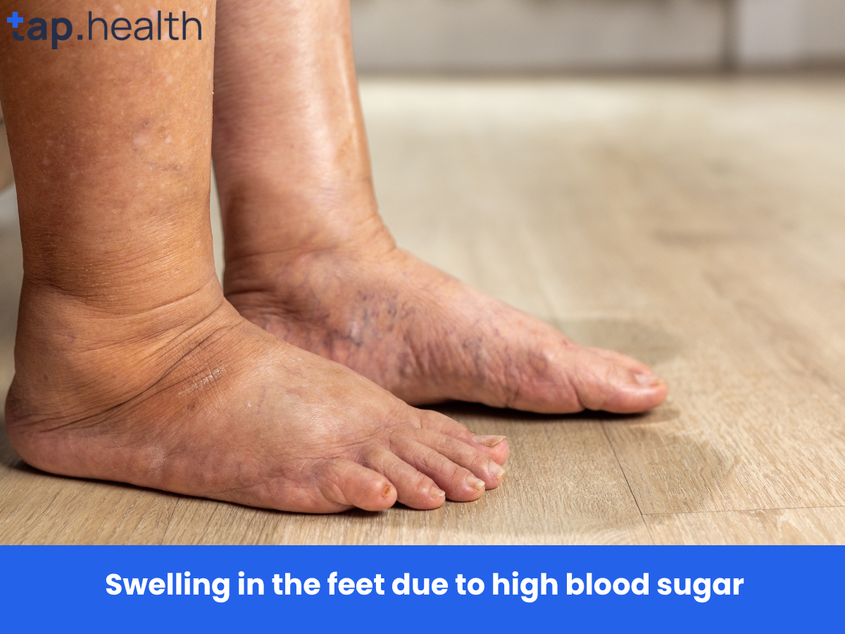 Swelling in the feet due to high blood sugar