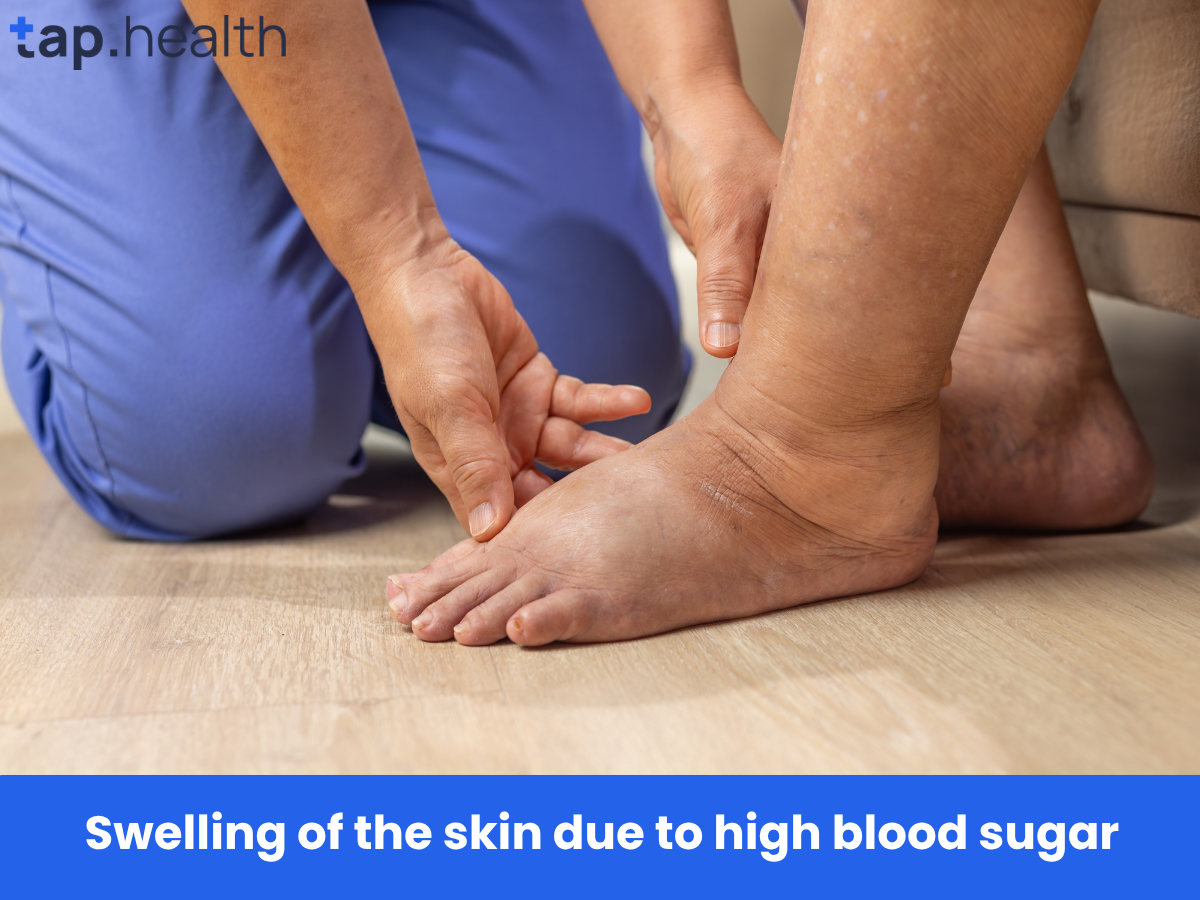 Swelling of the skin due to high blood sugar
