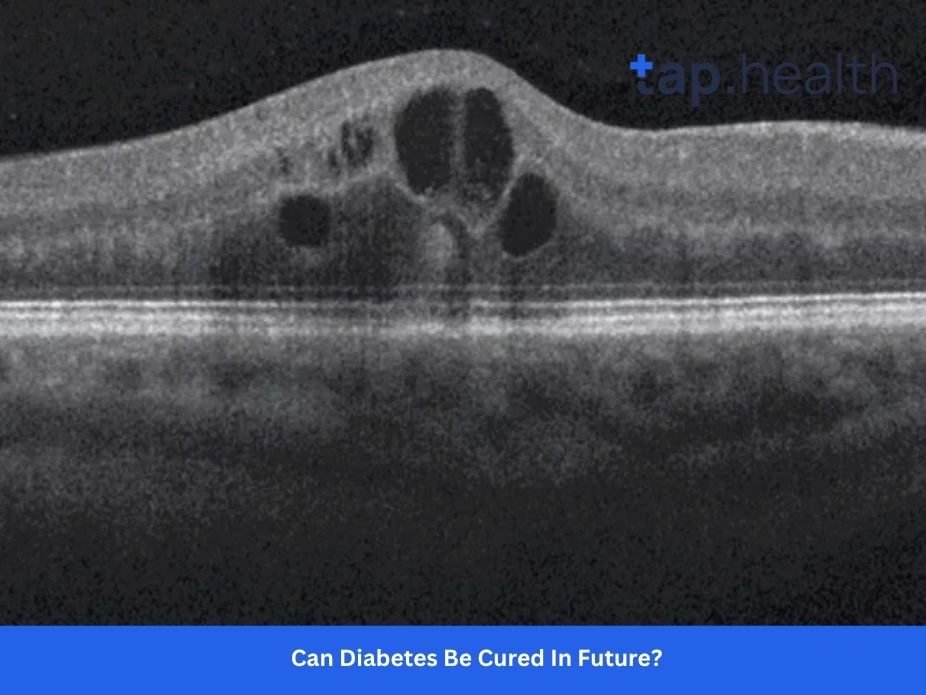 Pancakes for Diabetes Type 1: Delicious, Blood Sugar-Friendly Recipes and Tips