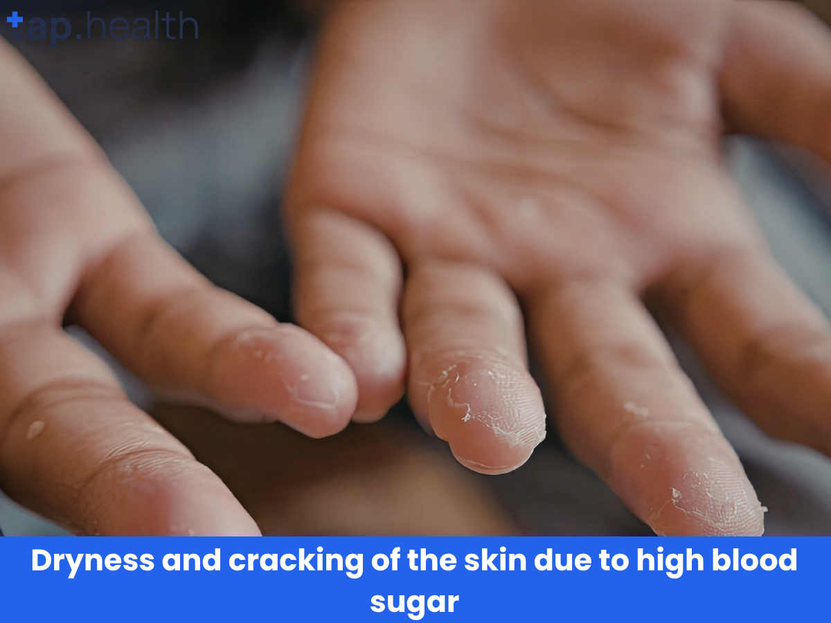 Dryness and cracking of the skin due to high blood sugar