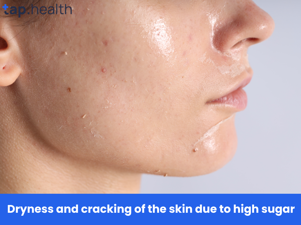 Dryness and cracking of the skin due to high sugar