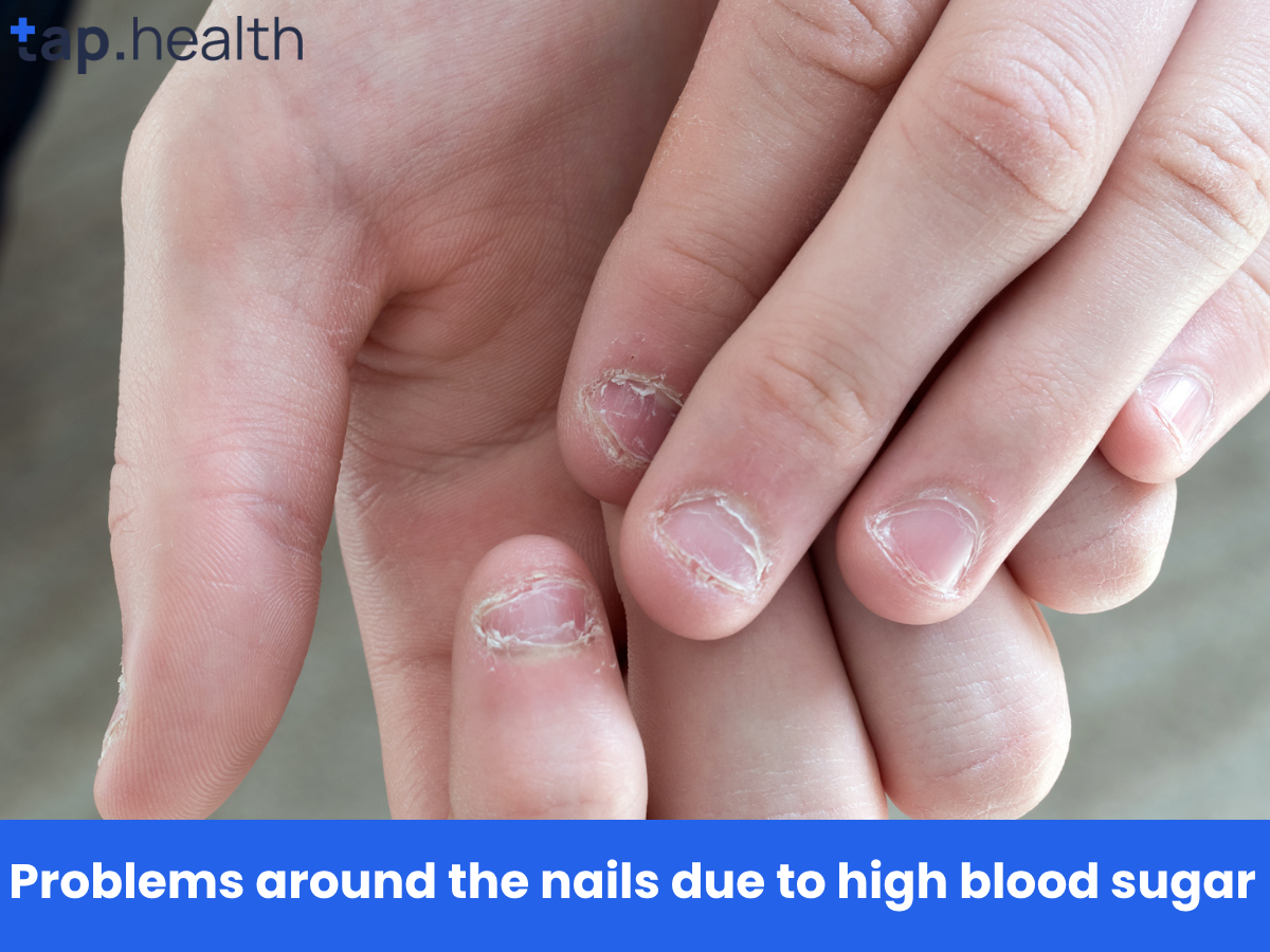 Problems around the nails due to high blood sugar