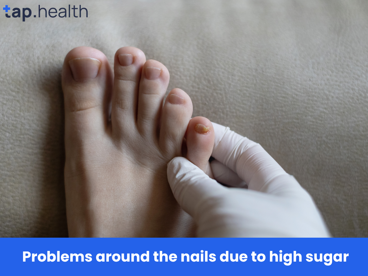 Problems around the nails due to high sugar