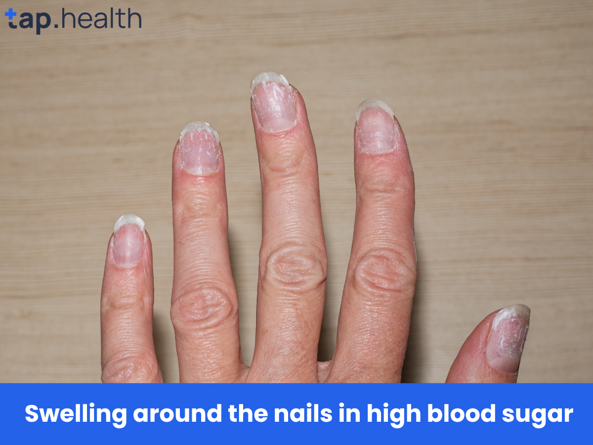 Swelling around the nails in high blood sugar