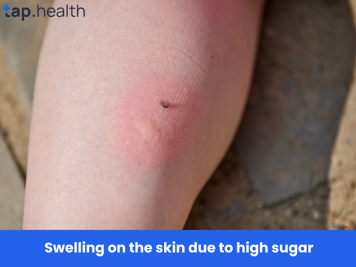 Swelling on the skin due to high sugar